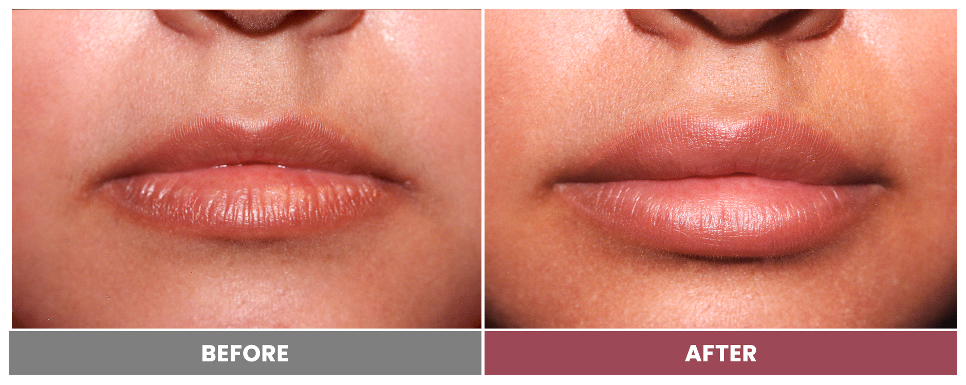 RESTYLANE - Case 6